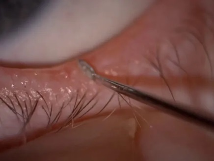 Eyelid Debridement img