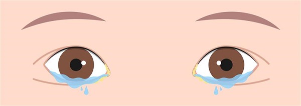 Lacrimal Syringing img